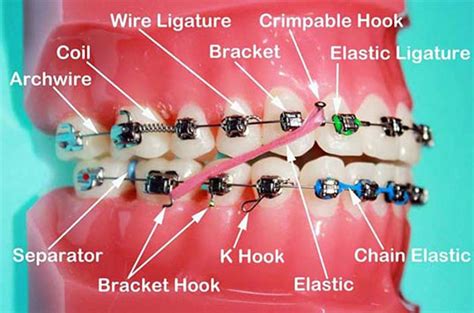 doe all metal braces brackets need wire|the final wire for braces.